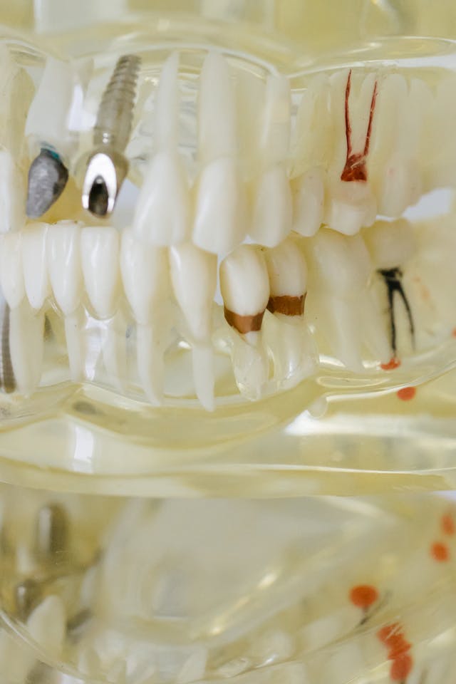 colocacion de implantes dentales