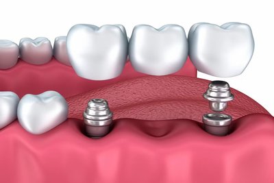 Tipos de Dentaduras postizas