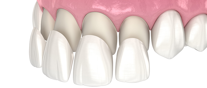 ventajas de las carillas dentales